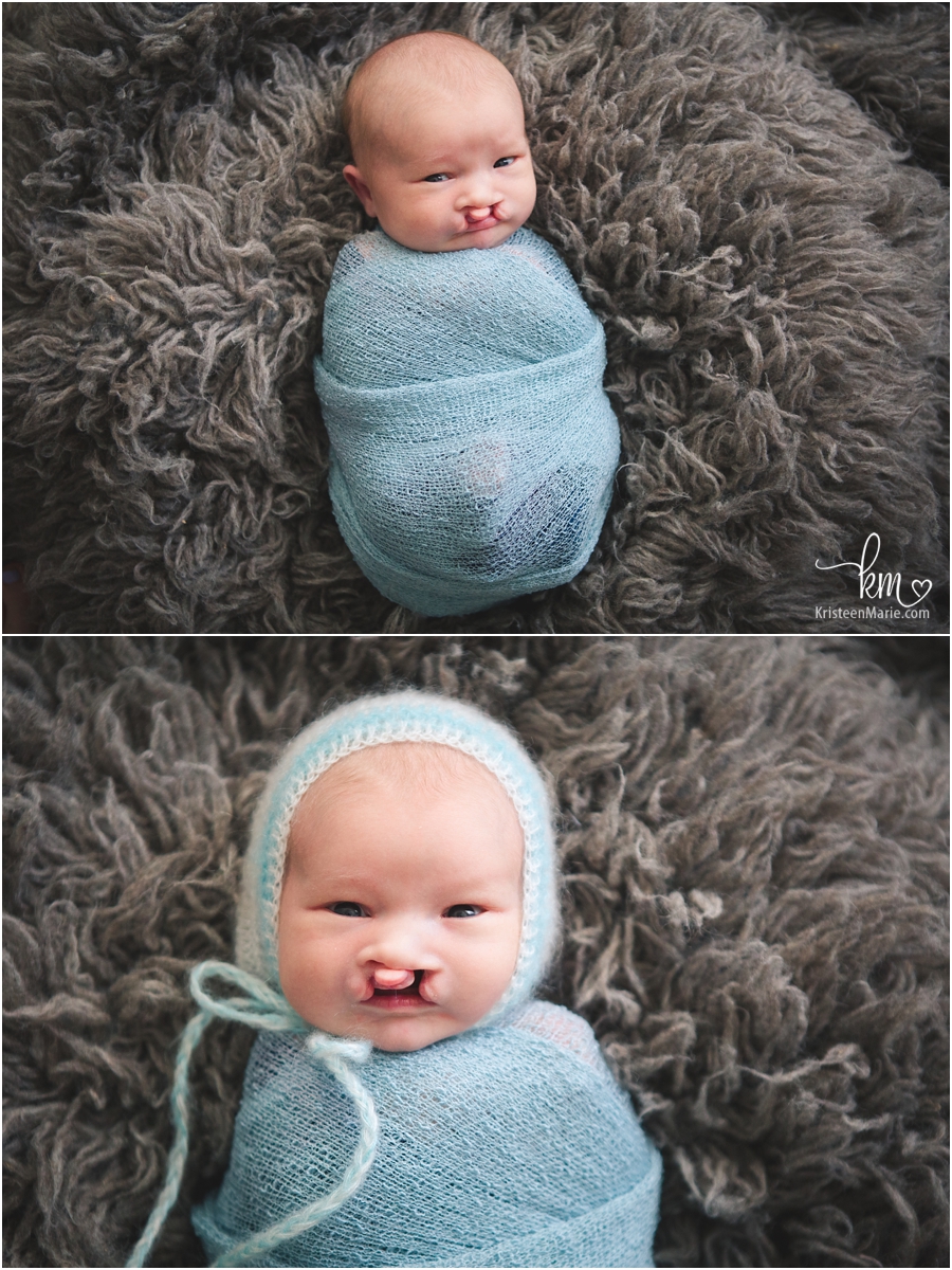 wrapped newborn baby boy with cleft lip