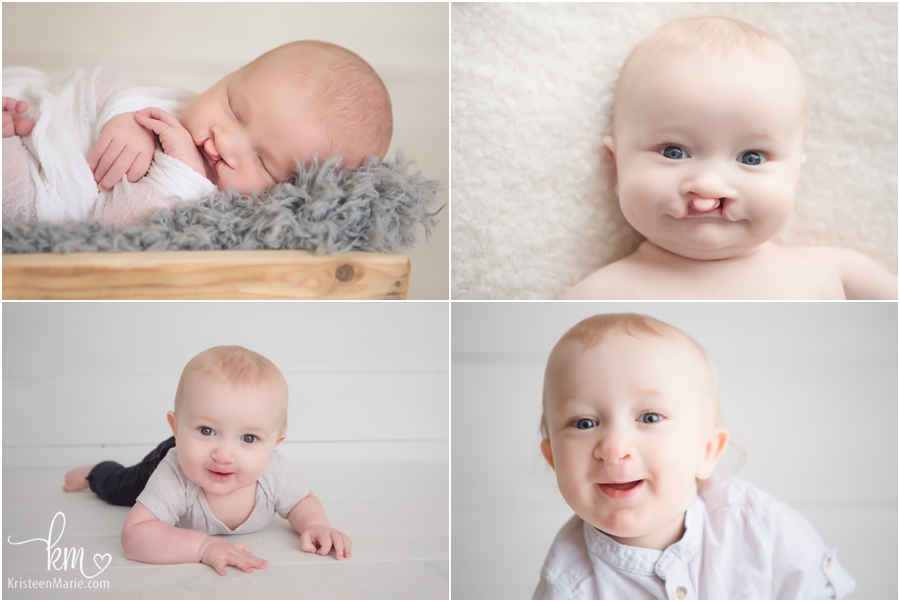 baby with cleft lip progresses over one year